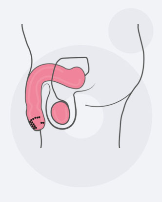 a test hofigalis méregtelenítése enyhíti a viszketést a genitális szemölcsöktől